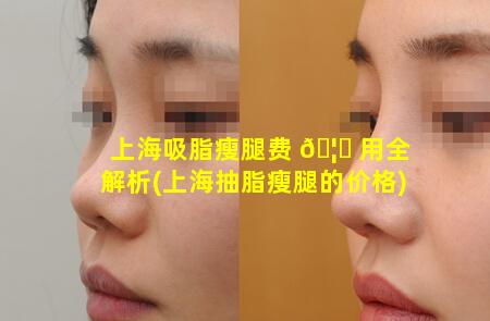 上海吸脂瘦腿费 🦅 用全解析(上海抽脂瘦腿的价格)